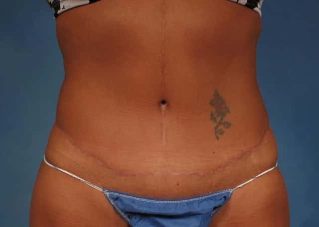 Liposuction Before & After Case 176 after