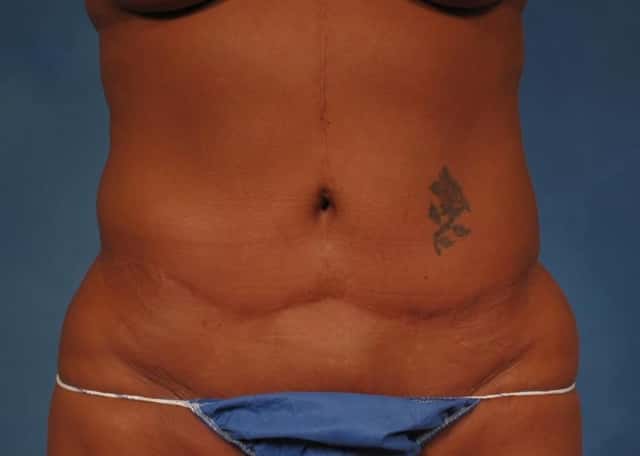 Liposuction Before & After Case 176 before