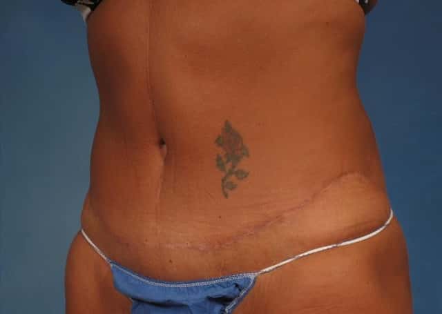 Liposuction Before & After Case 176 after