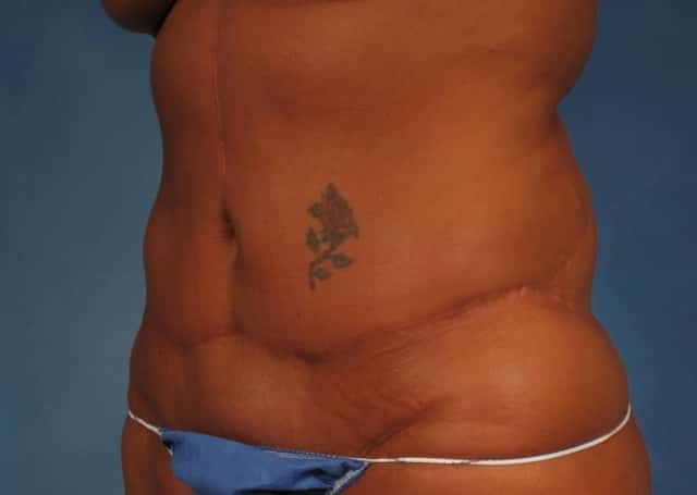 Liposuction Before & After Case 176 before