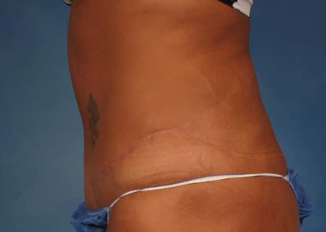 Liposuction Before & After Case 176 after