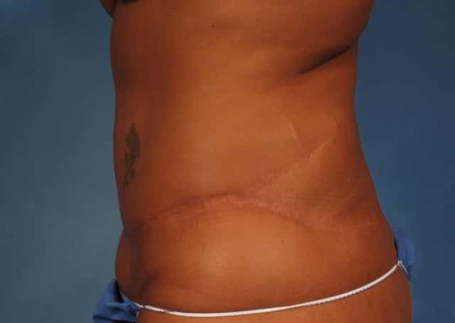 Liposuction Before & After Case 176 before