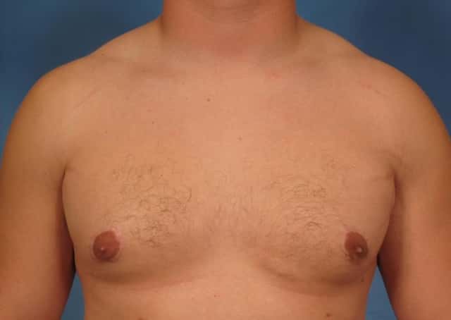 Liposuction Before & After Case 177 after