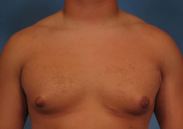 Liposuction Before & After Case 177 before