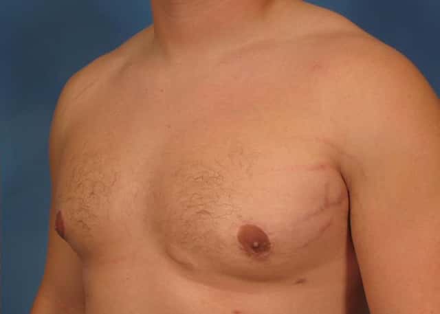 Liposuction Before & After Case 177 after