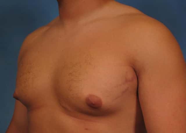 Liposuction Before & After Case 177 before