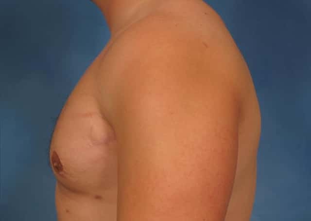 Liposuction Before & After Case 177 after