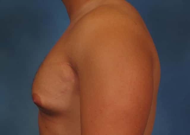 Liposuction Before & After Case 177 before