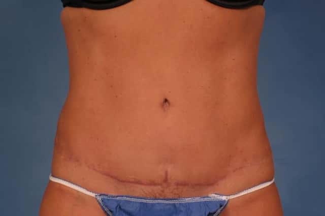 Liposuction Before & After Case 216 after
