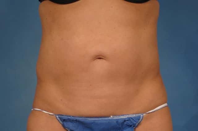 Liposuction Before & After Case 216 before