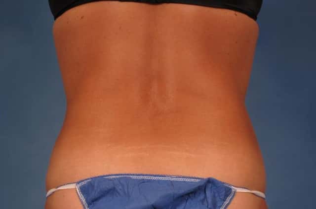Liposuction Before & After Case 216 after