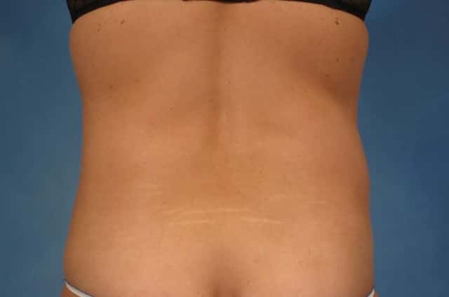 Liposuction Before & After Case 216 before