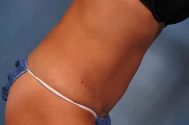 Liposuction Before & After Case 216 after