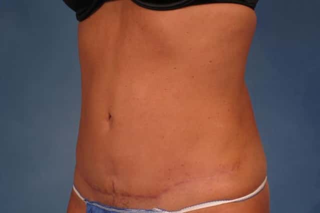 Liposuction Before & After Case 216 after