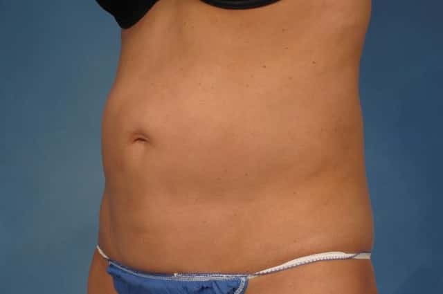Liposuction Before & After Case 216 before