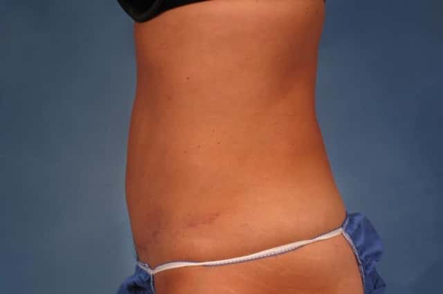 Liposuction Before & After Case 216 after