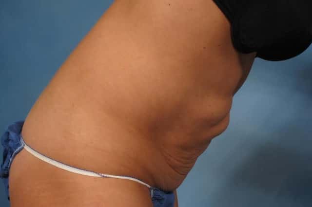 Liposuction Before & After Case 235 before
