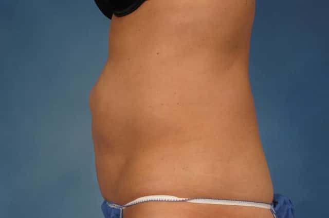 Liposuction Before & After Case 235 before