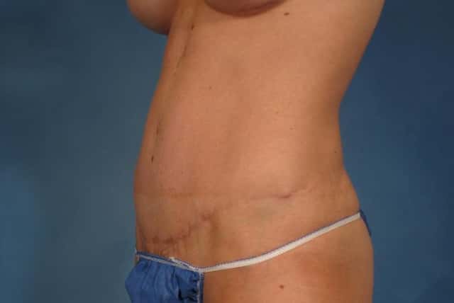 Liposuction Before & After Case 236 after