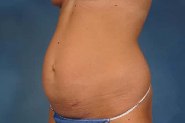 Liposuction Before & After Case 236 before