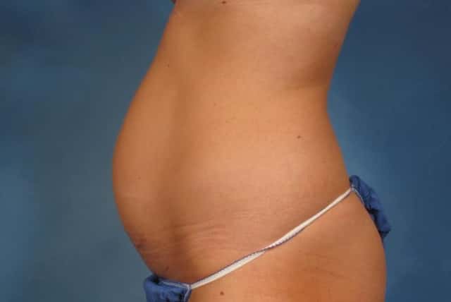 Liposuction Before & After Case 236 before