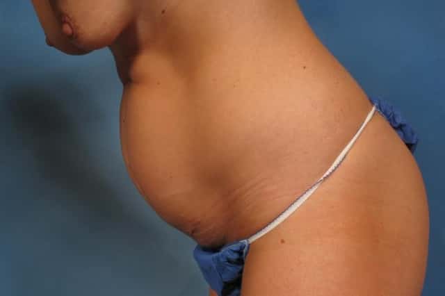 Liposuction Before & After Case 236 before