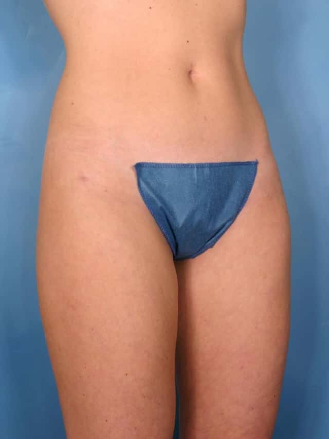 Liposuction Before & After Case 25 after
