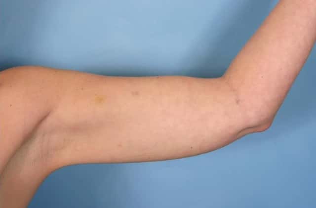 Liposuction Before & After Case 28 after