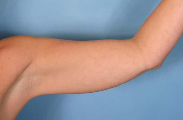 Liposuction Before & After Case 28 before