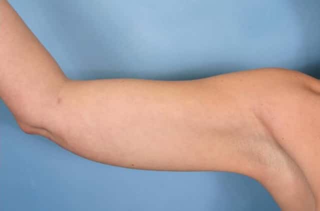 Liposuction Before & After Case 28 after