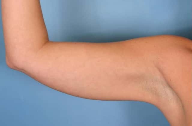 Liposuction Before & After Case 28 before