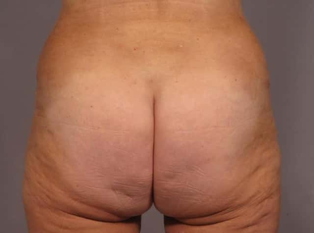 Liposuction Before & After Case 292 after