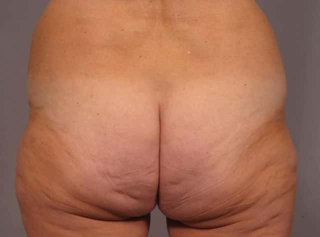 Liposuction Before & After Case 292 before