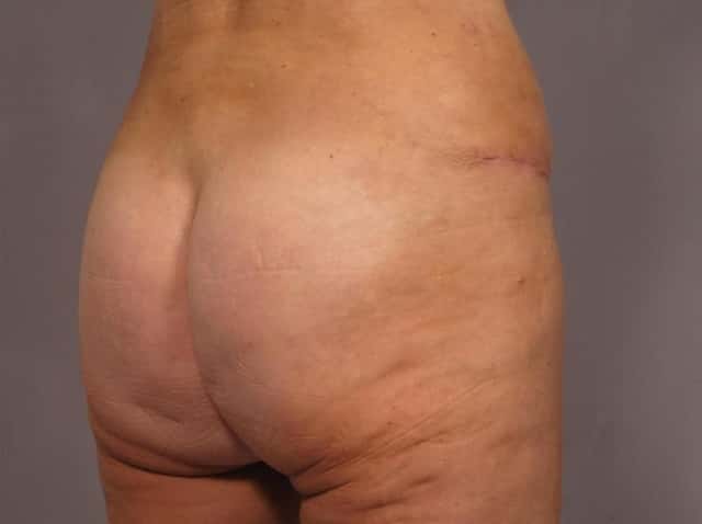 Liposuction Before & After Case 292 after