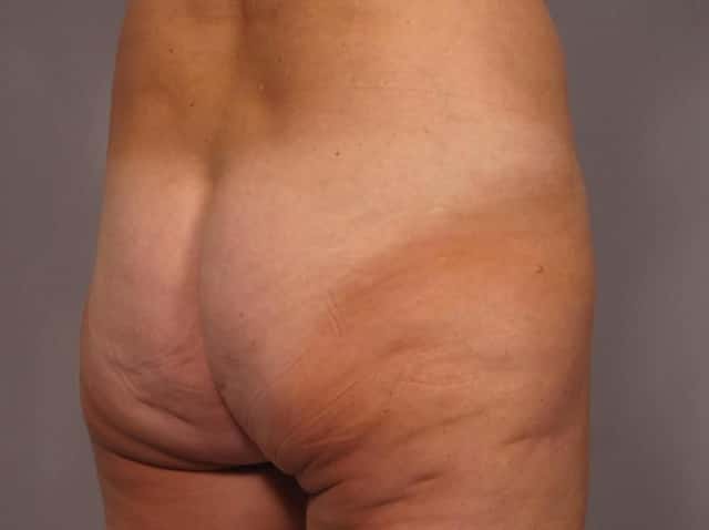 Liposuction Before & After Case 292 before