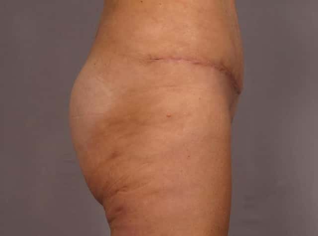 Liposuction Before & After Case 292 after