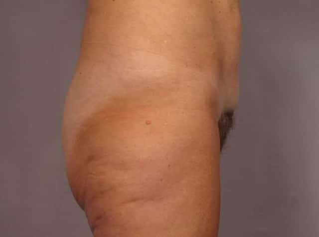 Liposuction Before & After Case 292 before