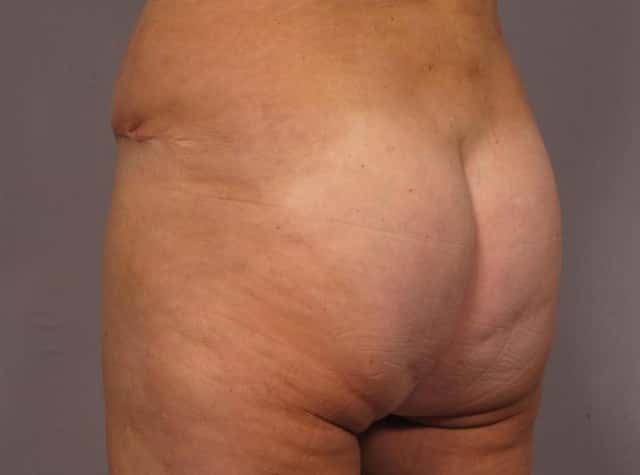 Liposuction Before & After Case 292 after