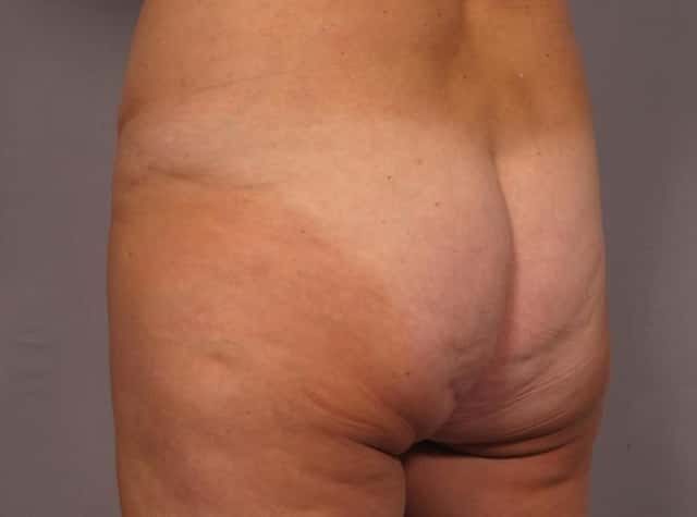Liposuction Before & After Case 292 before