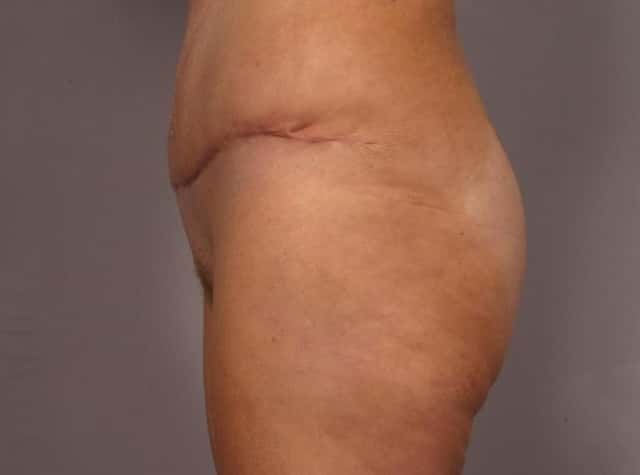 Liposuction Before & After Case 292 after