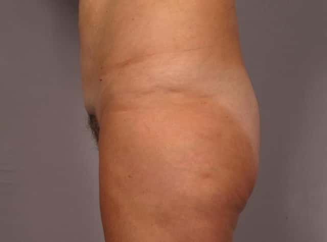 Liposuction Before & After Case 292 before
