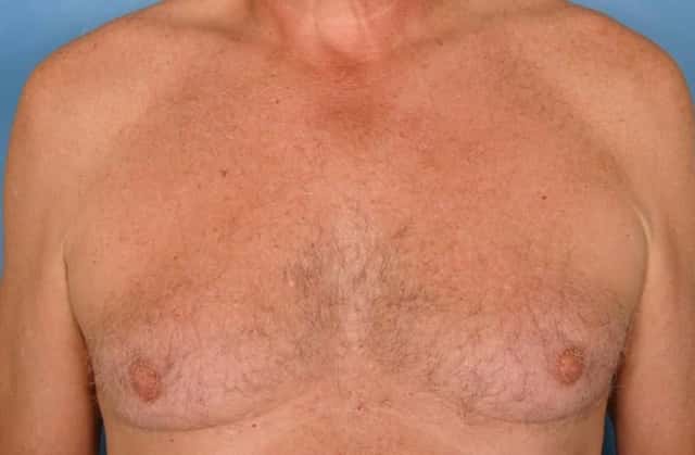 Liposuction Before & After Case 30 before