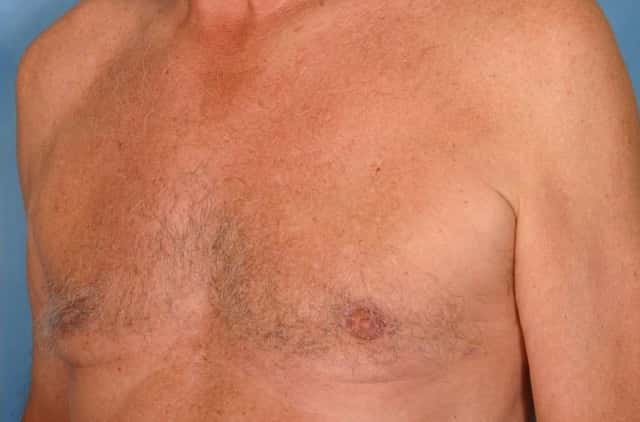 Liposuction Before & After Case 30 after