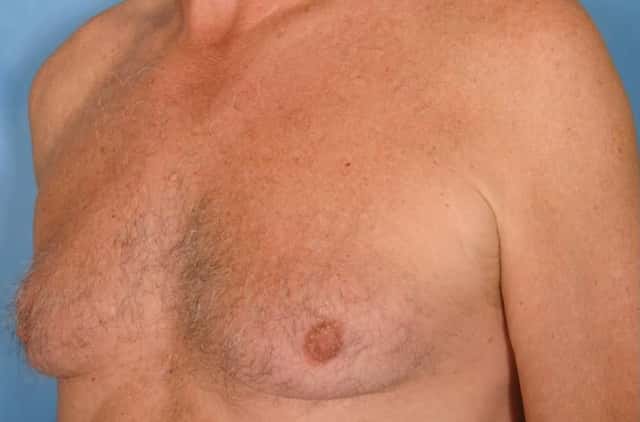 Liposuction Before & After Case 30 before