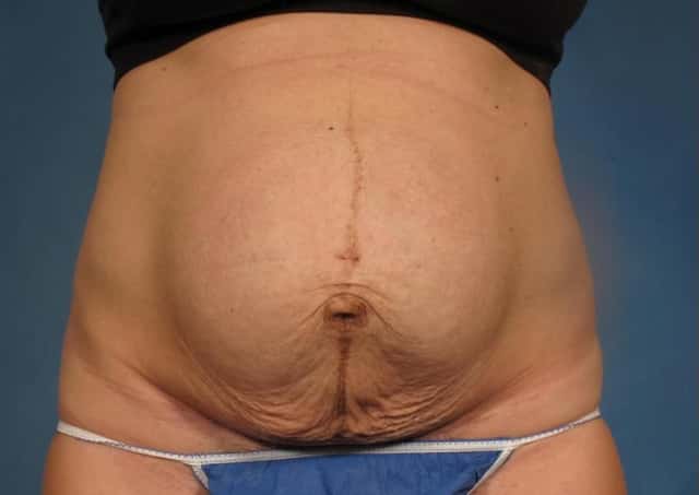 Liposuction Before & After Case 305 before