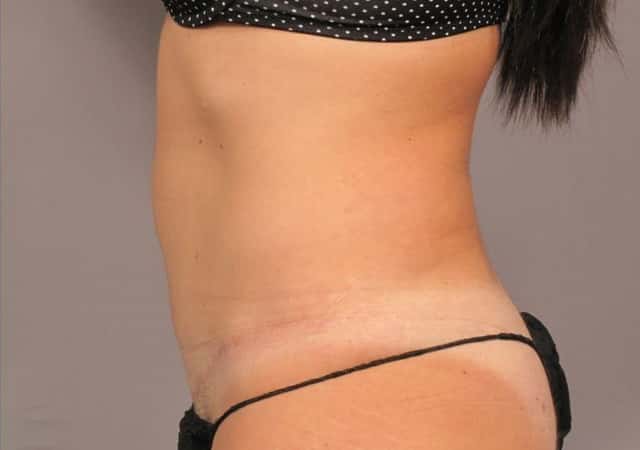 Liposuction Before & After Case 305 after