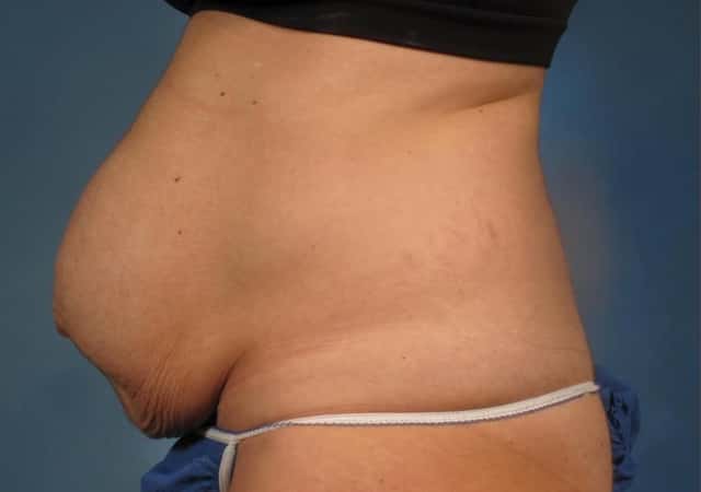 Liposuction Before & After Case 305 before
