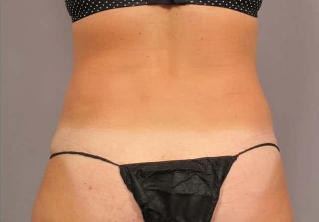 Liposuction Before & After Case 305 after