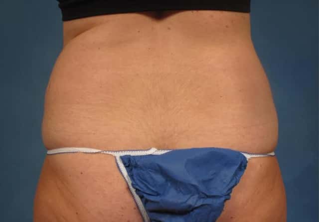 Liposuction Before & After Case 305 before