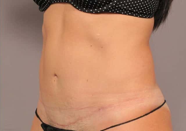 Liposuction Before & After Case 305 after